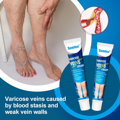 Varicose Veins Treatment for Legs