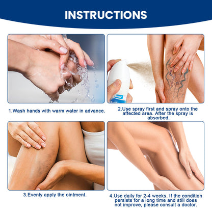 Varicose Veins Treatment for Legs